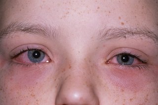 Picture of allergic conjunctivitis