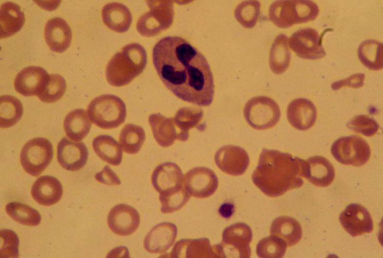 Железодефицитная анемия - анализ крови