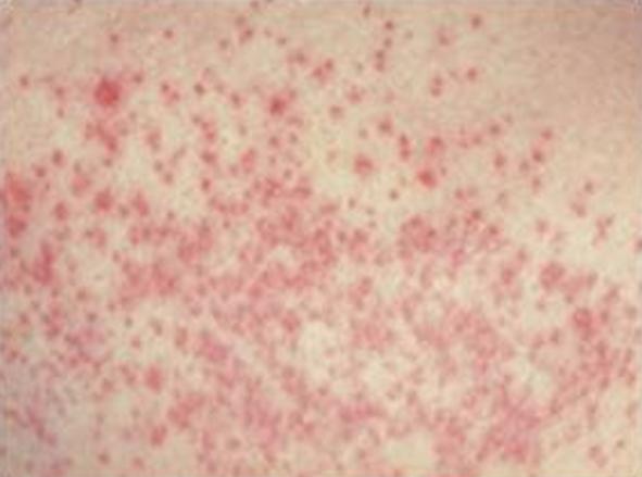 грибковая инфекция кожи