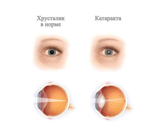 Катаракта слезится глаз. Катаракта схема глаза. Анатомия глаза катаракта. Нормальный глаз и катаракта. Как выглядит хрусталик глаза.
